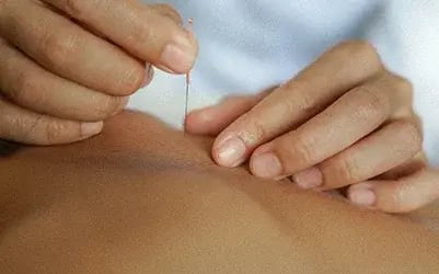 dry-needling-2